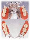 コバルトクロムの義歯