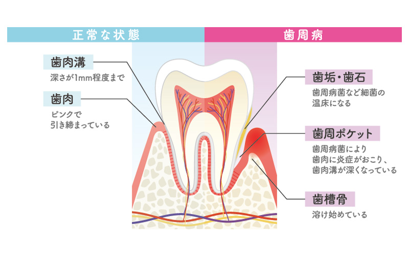 日本人の歯の失落原因の第一位である病気