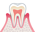レベル2　軽度歯周炎