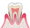 レベル3　中等度歯周炎