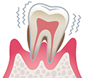 レベル4　重度歯周炎
