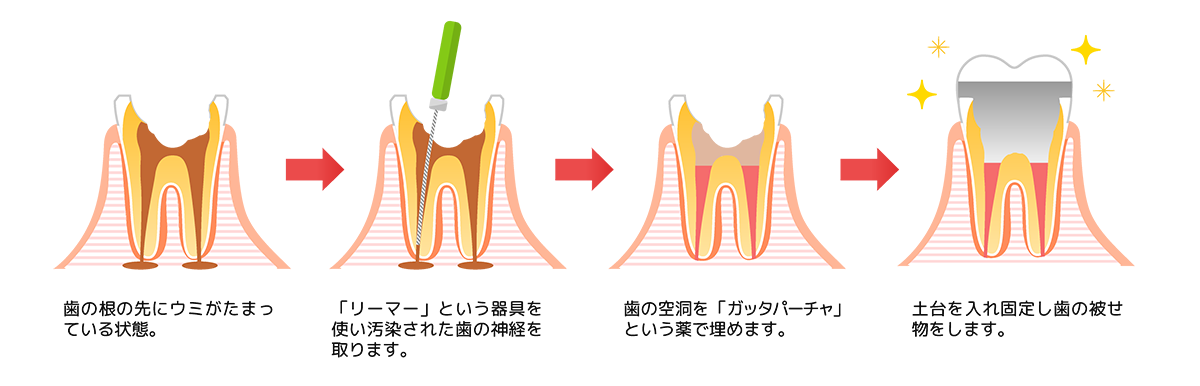 根管治療の種類