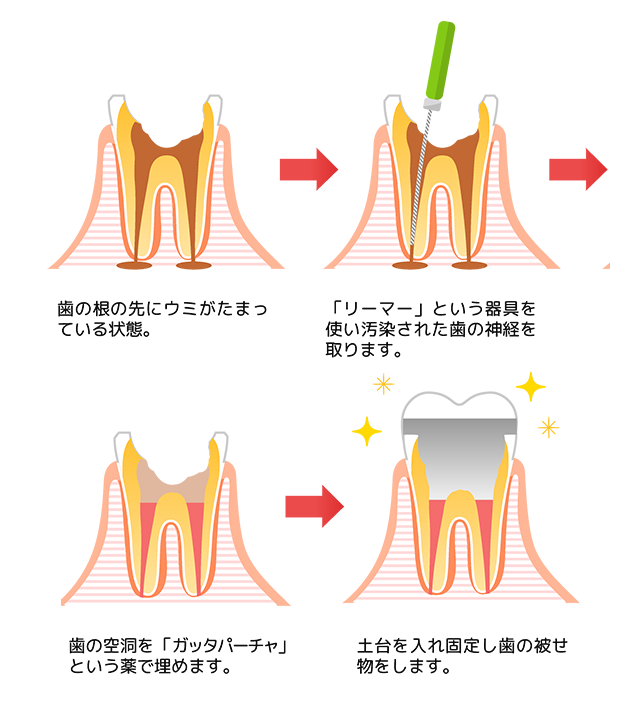 根管治療の種類