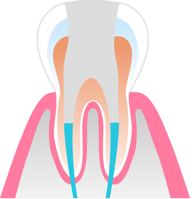 感染根管への治療