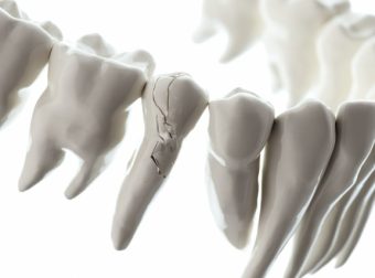 歯根破折がおこったら抜歯をしない選択は可能？抜歯を回避する方法とリスクについて
