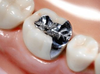 虫歯が再発したらどうなる？<br>及ぼす影響と再発を防ぐポイントについて解説