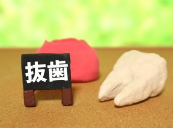 歯周病で抜歯が必要になるタイミングは？回避方法と抜歯後の選択肢についても解説