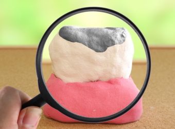 歯医者で入れた詰め物がすぐ取れたのは治療が下手だから？その対応法・予防法について