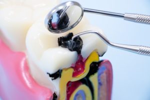 歯医者の定期健診は本当に必要？予防の重要性とメリット