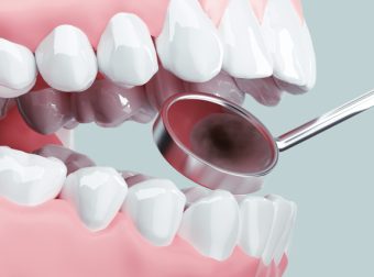 歯医者で行うフッ素塗布って？予防にフッ素が選ばれる理由と効果を高めるためのポイント
